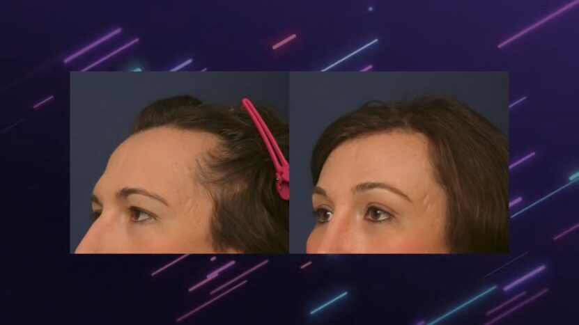 forehead Feminization